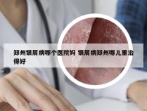 郑州银屑病哪个医院妈 银屑病郑州哪儿里治得好