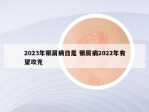 2023年银屑病日是 银屑病2022年有望攻克