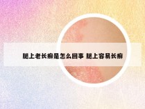 腿上老长癣是怎么回事 腿上容易长癣