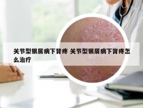 关节型银屑病下背疼 关节型银屑病下背疼怎么治疗