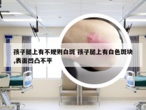 孩子腿上有不规则白斑 孩子腿上有白色斑块,表面凹凸不平