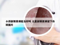 小孩副银屑病能治好吗 儿童副银屑病留下白斑图片