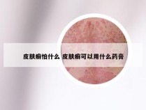 皮肤癣怕什么 皮肤癣可以用什么药膏