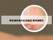 银肖病咋查什么引起的 银肖病照片