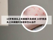 14岁男孩头上长癣图片及症状 14岁男孩头上长癣图片及症状怎么治疗