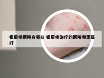 银屑病医院有哪些 银屑病治疗的医院哪里最好