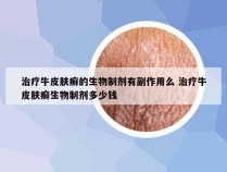 治疗牛皮肤癣的生物制剂有副作用么 治疗牛皮肤癣生物制剂多少钱