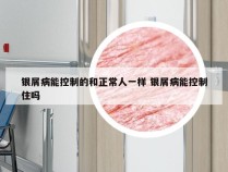 银屑病能控制的和正常人一样 银屑病能控制住吗