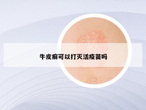 牛皮癣可以打灭活疫苗吗