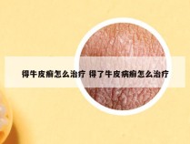 得牛皮癣怎么治疗 得了牛皮病癣怎么治疗