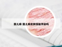 圈儿癣 圈儿癣皮肤接触传染吗