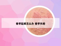 春季起癣怎么办 春季长癣