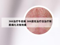 308治疗牛皮癣 308激光治疗仪治疗银屑病几次有效果