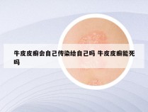 牛皮皮癣会自己传染给自己吗 牛皮皮癣能死吗