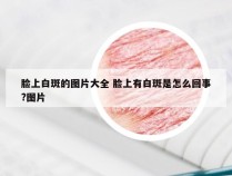 脸上白斑的图片大全 脸上有白斑是怎么回事?图片