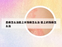 患癣怎么治脸上长饭癣怎么治 脸上的饭癣怎么治