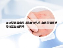 血热型银屑病可以涂身体乳吗 血热型银屑病能吃活血的药吗