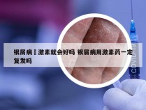 银屑病摖激素就会好吗 银屑病用激素药一定复发吗