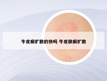 牛皮癣扩散的快吗 牛皮肤癣扩散