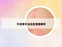 牛皮癣不治会危害健康吗