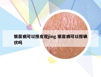 银屑病可以擦皮现jing 银屑病可以擦碘伏吗