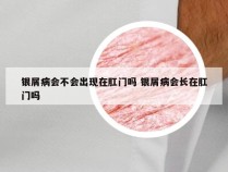 银屑病会不会出现在肛门吗 银屑病会长在肛门吗