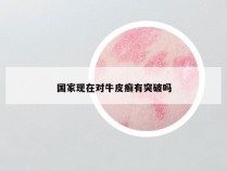 国家现在对牛皮癣有突破吗