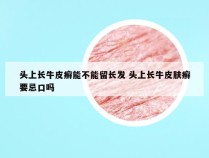 头上长牛皮癣能不能留长发 头上长牛皮肤癣要忌口吗