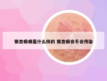 银杏癣病是什么样的 银杏癣会不会传染