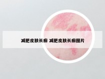 减肥皮肤长癣 减肥皮肤长癣图片