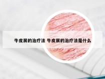 牛皮屑的治疗法 牛皮屑的治疗法是什么