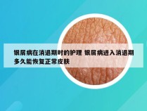 银屑病在消退期时的护理 银屑病进入消退期多久能恢复正常皮肤