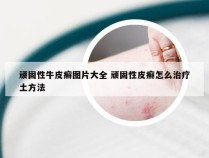 顽固性牛皮癣图片大全 顽固性皮癣怎么治疗土方法