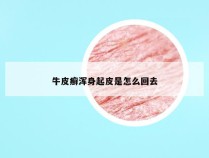 牛皮癣浑身起皮是怎么回去