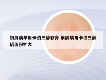 银屑病单用卡泊三醇软膏 银屑病用卡泊三醇后面积扩大