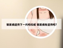 银屑病遗传下一代吗权威 银屑病有遗传吗?