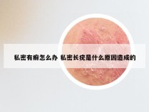 私密有癣怎么办 私密长疣是什么原因造成的