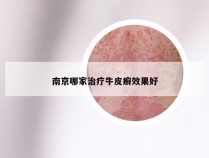 南京哪家治疗牛皮癣效果好