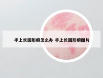 手上长圆形癣怎么办 手上长圆形癣图片