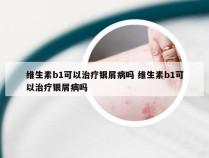 维生素b1可以治疗银屑病吗 维生素b1可以治疗银屑病吗