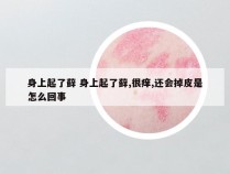 身上起了藓 身上起了藓,很痒,还会掉皮是怎么回事