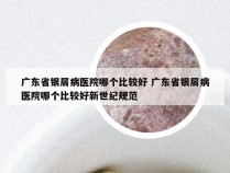 广东省银屑病医院哪个比较好 广东省银屑病医院哪个比较好新世纪规范