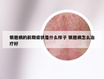 银翘病的前期症状是什么样子 银翘病怎么治疗好