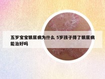 五岁宝宝银屑病为什么 5岁孩子得了银屑病能治好吗