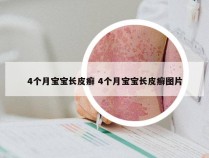 4个月宝宝长皮癣 4个月宝宝长皮癣图片