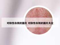 对称性白斑的图片 对称性白斑的图片大全