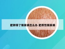 肥胖得了银屑病怎么办 肥厚性银屑病