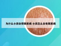 为什么小孩会得银屑病 小孩怎么会有银屑病