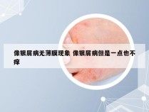 像银屑病无薄膜现象 像银屑病但是一点也不痒