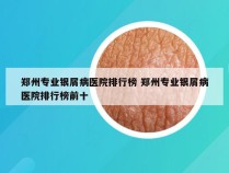 郑州专业银屑病医院排行榜 郑州专业银屑病医院排行榜前十